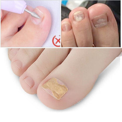 100 PCS Fertoe™ Toenail Corrector Patch