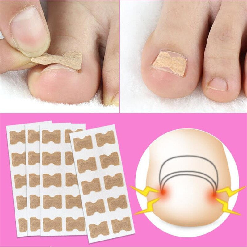 100 PCS Fertoe™ Toenail Corrector Patch